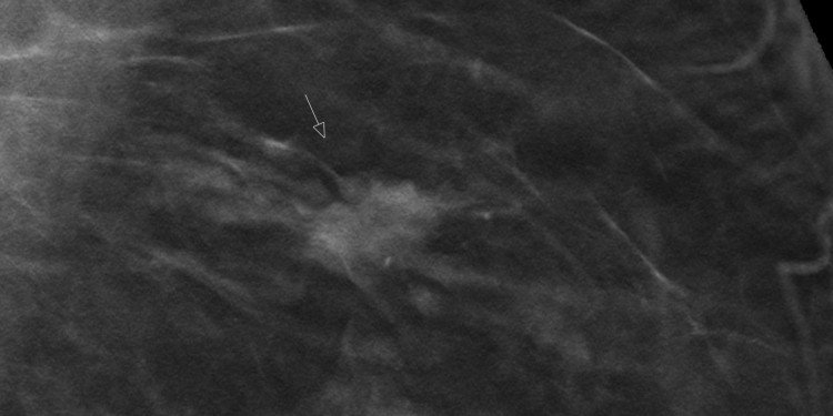 Das Bild zeigt eine medizinische Schichtaufnahme der Brust. Ein Pfeil zeigt auf eine erkennbare Struktur.© Referenzzentrum Mammographie Münster